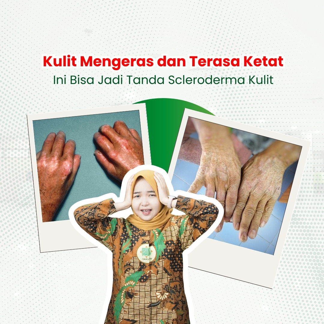 Kulit-Mengeras-dan-Terasa-ketat-ini-bisa-jadi-tanda-scleroderma-kulit.jpeg