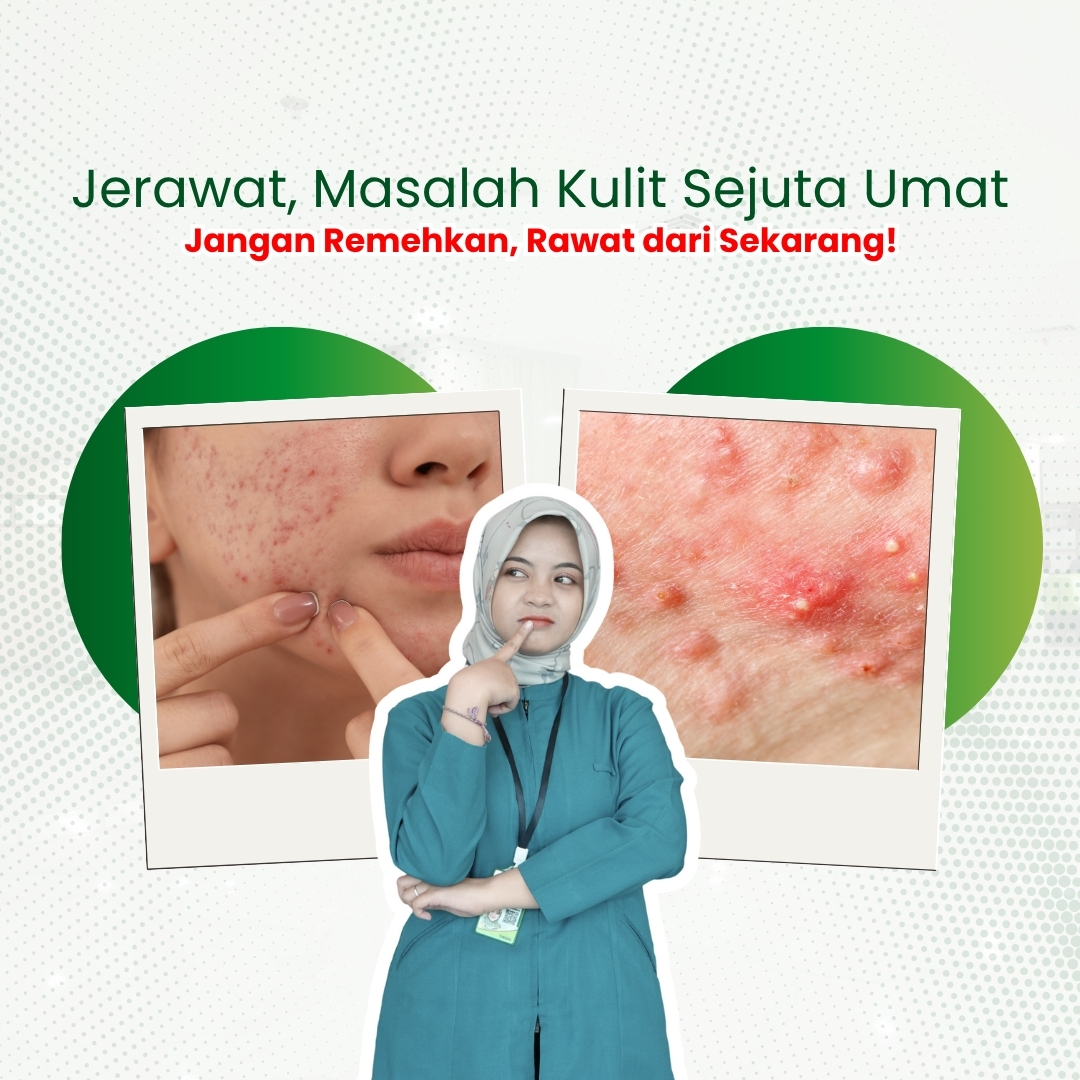 Jerawat-Masalah-Kulit-Sejuta-Umat-yang-Tak-Boleh-Diremehkan.jpg
