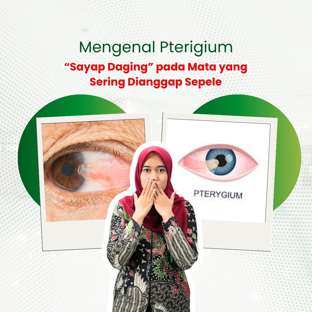 Mengenal-Pterigium-Sayap-Daging-pada-Mata-yang-Sering-Dianggap-Sepele.jpeg