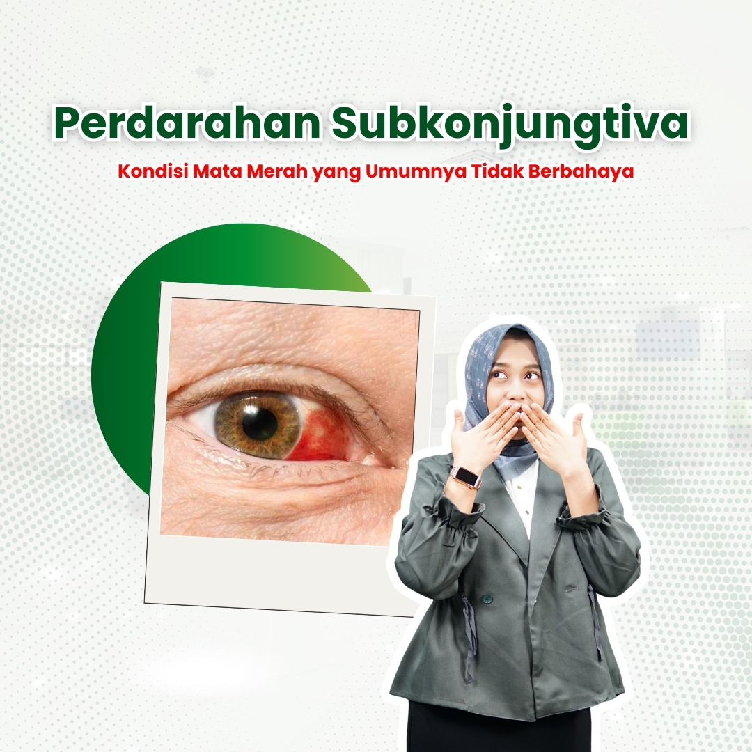 Perdarahan-Subkonjungtiva-Kondisi-Mata-Merah-yang-Umumnya-Tidak-Berbahaya.jpeg